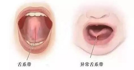 舌系帶過長影響孩子發(fā)音,嚴重不會說話